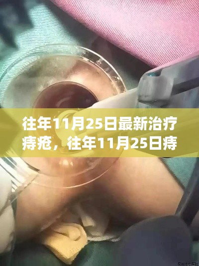 往年11月25日痔疮最新治疗技术与概览，痔疮治疗新技术概览
