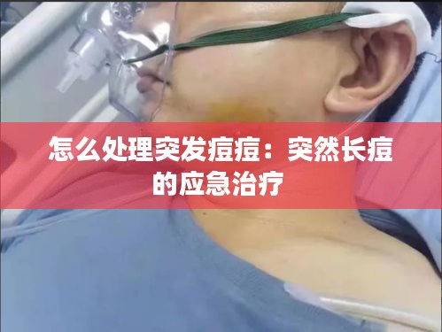 怎么处理突发痘痘：突然长痘的应急治疗 
