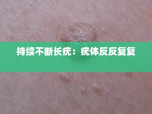 持续不断长疣：疣体反反复复 