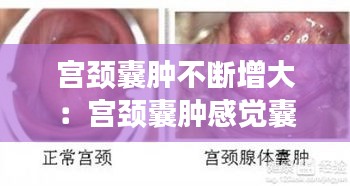 宫颈囊肿不断增大：宫颈囊肿感觉囊肿又变大了 