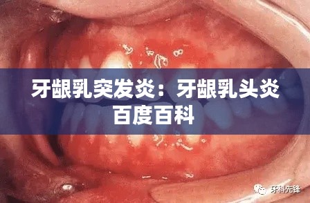 牙龈乳突发炎：牙龈乳头炎百度百科 