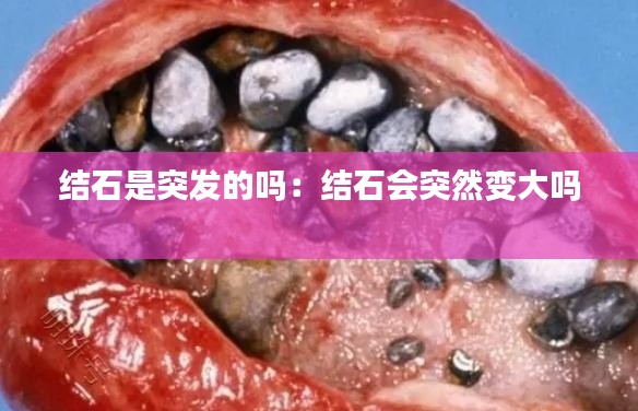 结石是突发的吗：结石会突然变大吗 