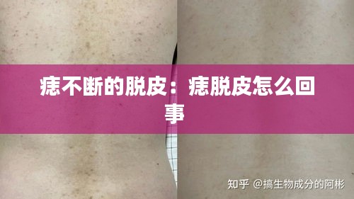 痣不断的脱皮：痣脱皮怎么回事 