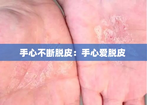 手心不断脱皮：手心爱脱皮 