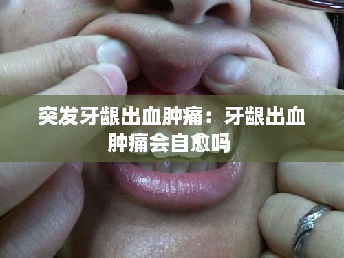 突发牙龈出血肿痛：牙龈出血肿痛会自愈吗 