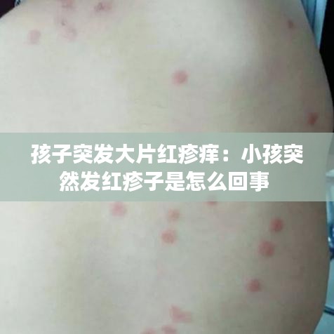 孩子突发大片红疹痒：小孩突然发红疹子是怎么回事 