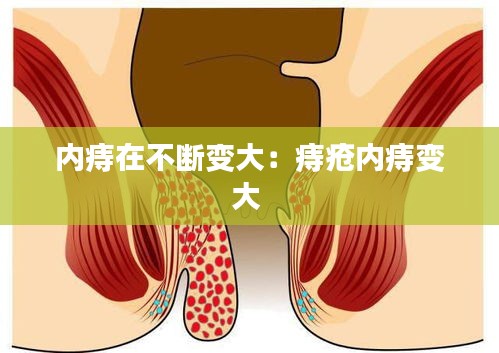 内痔在不断变大：痔疮内痔变大 