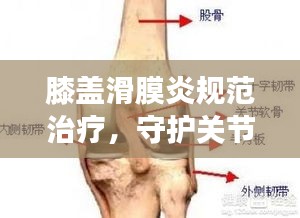 膝盖滑膜炎规范治疗，守护关节健康！